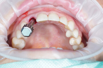 Modern approaches for simultaneous dental implantation into the hole of a removed tooth. High...