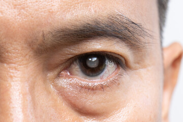 Senior man has cataracts. Generally, cataracts are common in older people.