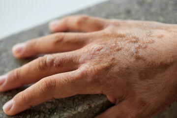 Close-up of Chronic skin diseases dermatitis - obrazy, fototapety, plakaty