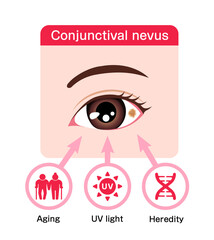 Causes of Conjunctival nevus vector illustration