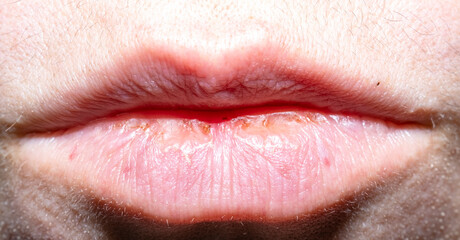 Women's lips after high body temperature, lips cracked with blood. Dry lips.