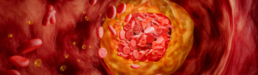 Hyperlipidemia or arteriosclerosis. Blocked artery concept and human blood vessel as a disease with cholesterol fat buildup clogging. Clogged arteries, Cholesterol plaque in the artery. 3D Rendering.