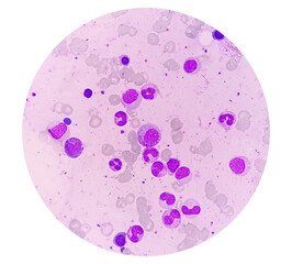 Bone marrow study: Suggestive of reactive marrow with dimorphic Erythroid hyperplasia