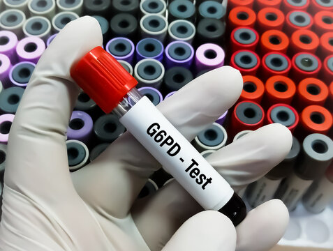G6PD (glucose 6 phosphate dehydrogenase) test