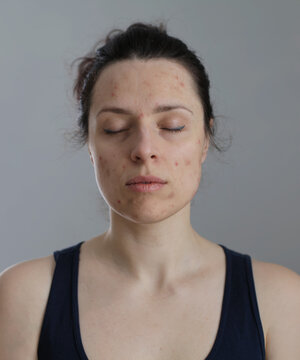 Unretouched image of woman with dry damaged skin on her face and lips on light gray backgound