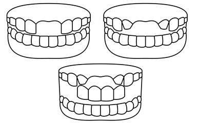 Illustration of a bridge over a missing front tooth, simple line drawing
