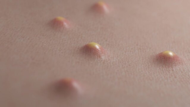 Acne pops out of the skin because of clogged pores