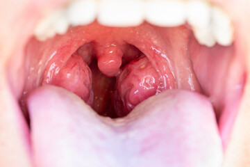 The child is a patient with large red glands. Tonsils in close-up in the mouth. Closeup view of open mouth with tonsils - obrazy, fototapety, plakaty