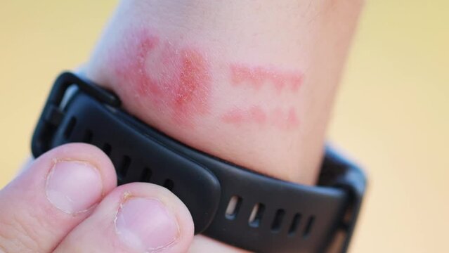 Redness and allergies on a person s wrist from wearing a fitness bracelet with a silicone strap. Contact dermatitis, close-up
