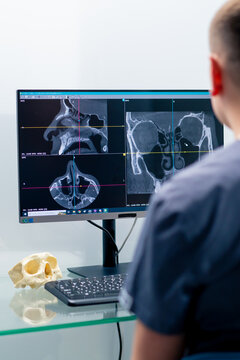 a radiologist doctor looks at a screen showing a 3D image of a nose scan to determine the results of plastic surgery in a clinic