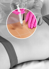 Aesthetic cosmetologist makes lipolytic injections to burn fat on the body of a woman. Female aesthetic cosmetology in a beauty salon.Cosmetology concept.