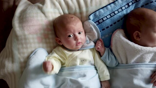 Two baby twins lie on the bed, one hase hemangioma on its head