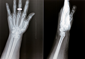 Colles' fracture of an old female, a type of fracture of the distal forearm in which the broken end...