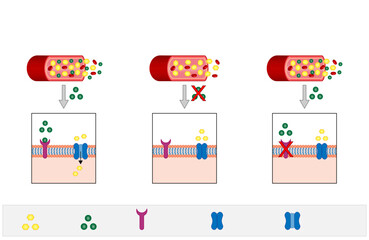 Diabetes mellitus type 1, pancreas's failure to produce enough insulin and type 2, cells fail to respond to insulin (Insulin resistance). Result in high blood glucose levels. Vector illustration