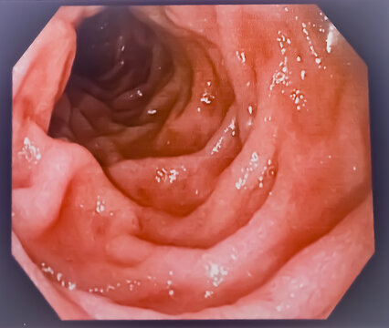 Hiatus hernia with severe gastritis. Gastrointestinal endoscopy, medical imaging EGD looking for structures in the esophagus. Medical image concept.