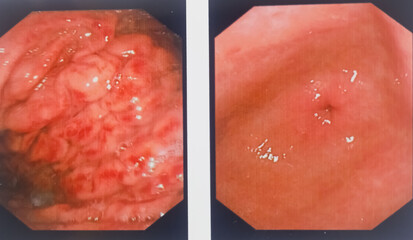Hiatus hernia with severe gastritis. Gastrointestinal endoscopy, medical imaging EGD looking for...