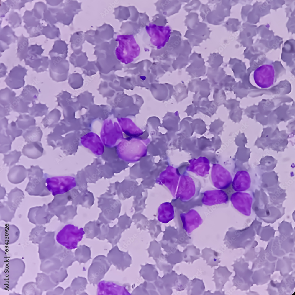 Wall mural Leukemia. blood cells, blast cells and immature leukocytic cells in chronic lymphocytic leukemia, prolymphocytic leukemia, acute lymphoblastic leukemia.