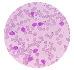 Leukemia. blood cells, blast cells and immature leukocytic cells in chronic lymphocytic leukemia,...