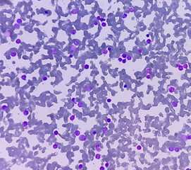 Leukemia. blood cells, blast cells and immature leukocytic cells in chronic lymphocytic leukemia, prolymphocytic leukemia, acute lymphoblastic leukemia.