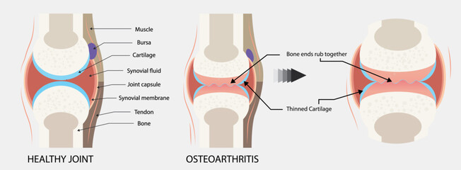 Rheumatoid arthritis, osteoarthritis of the joint. Images of healthy and diseased joints with main parts labeled, isolated on white, Vector, illustration, comparison, healthy joint, and arthritis. - obrazy, fototapety, plakaty