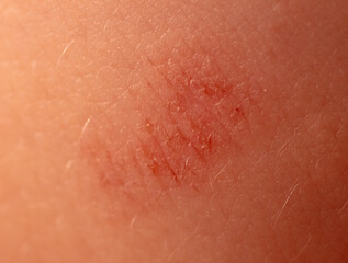 Close-up of a wound on a person's skin. Macro