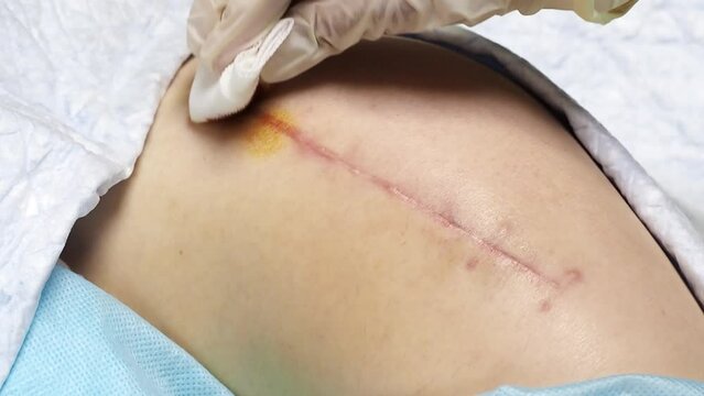 Top view of a suture on the thigh of a lying man, what the suture looks like 2 months after a total hip replacement, close up. Treating the seam with a special product - liquid with iodine