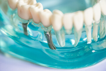 Dental implant, artificial tooth roots into jaw, root canal of dental treatment, gum disease, teeth...