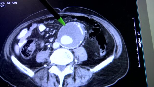 Medical aneurysm in abdomen at Cat Scan