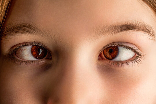 Little patient strabismus, treatment ophthalmic diseases. Strabismus in children causes, treatment concept. Female eyes with strabismus. Hypertropia. Strabismus. Close-up part child's face, eyes girl