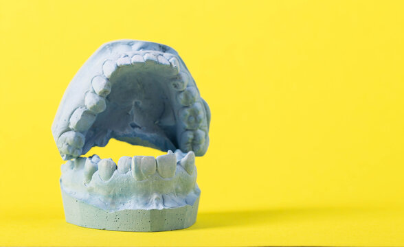 Blue plaster impression of a patient's dental jaw with crooked teeth and malocclusions on a yellow background. Manufacturing of bridges, crowns of various types, macro.