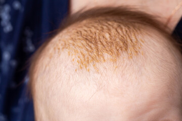 Milk crusts on the head of a newborn child, gneiss. The formation of yellow-golden scales on the...
