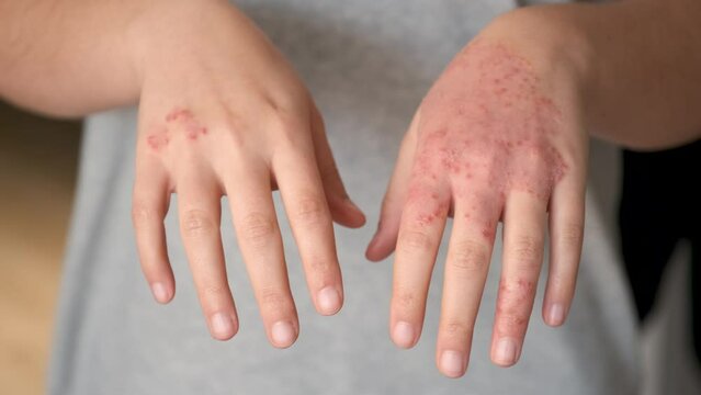 Unrecognizable woman with eczema on hands, atopic dermatitis concept.