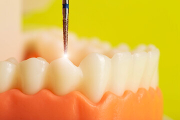 Drilling a diseased tooth with caries with a drill in dentistry during dental treatment, macro....