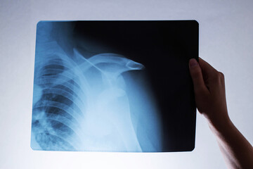 A woman's hand holds an x-ray of a patient with a dislocated shoulder and a fractured collarbone, osteoporosis. Surgery to reconstruct the shoulder joint, radiography - obrazy, fototapety, plakaty