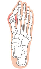 外反母趾　段階　足の骨　骨格図