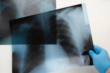 A hand in a blue medical glove holding one x-ray of lungs on the background of another. Disease progression, progressive lung disease