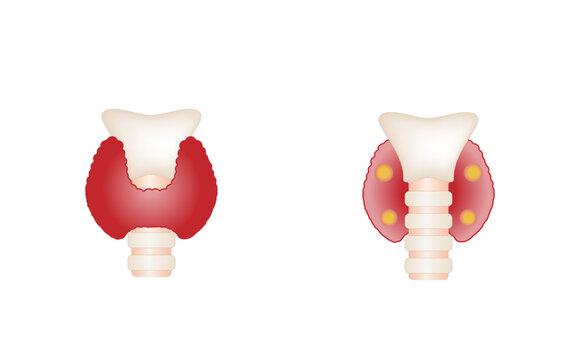 Thyroid and parathyroid gland. Anatomy front and back view of thyroid gland. hypothyroidism vs hyperthyroidism. Vector illustration isolated on white background.