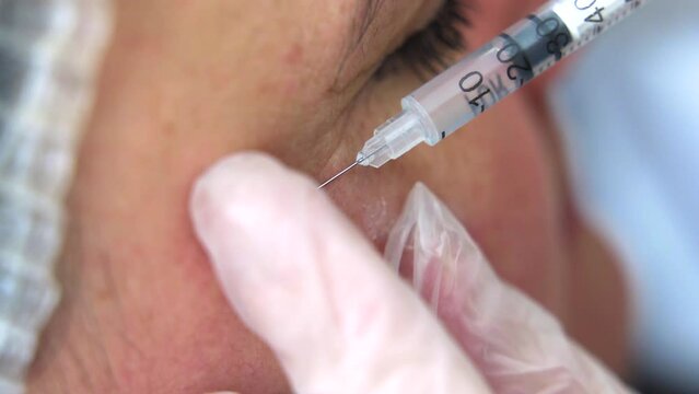Beautician doctor makes botox injection in the cheekbone of young beautiful woman. Extreme close up 4k shot