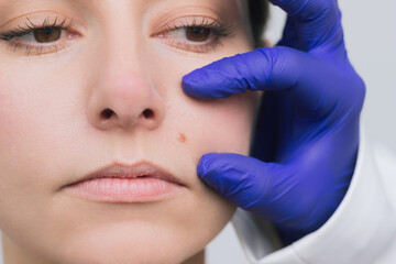 the mole above the lip on the face of a young woman increases in size. Indications for removal....