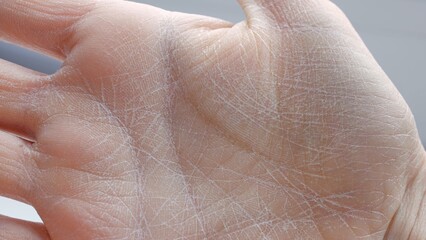 Dry skin on palm close-up side view peeling skin on palm lack of moisture dermatitis cosmetology and dermatology healthcare and medicine hand care, concept of problematic dry skin on palms of hands - obrazy, fototapety, plakaty