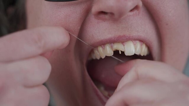 Dental floss important attribute of cleaning and hygiene oral cavity every day. Woman with bad teeth trying correct situation by flossing. Female with broken tooth. Damaged tooth cause poor hygiene.