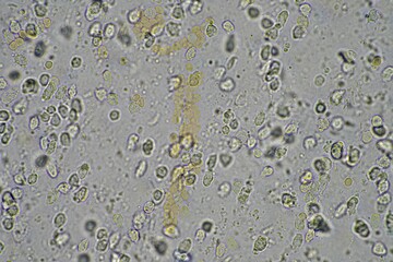 Coughing up mucus and phlegm from a chest infection from a virus and bacteria infection, looking at it under the microscope, with cells and microorganisms. Bacteria and skin cells close up