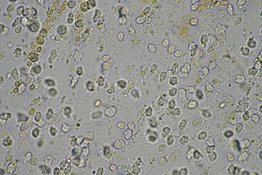 Coughing up mucus and phlegm from a chest infection from a virus and bacteria infection, looking at it under the microscope, with cells and microorganisms. Bacteria and skin cells close up