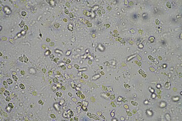 Coughing up mucus and phlegm from a chest infection from a virus and bacteria infection, looking at it under the microscope, with cells and microorganisms. Bacteria and skin cells close up