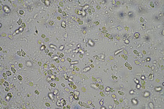 Coughing up mucus and phlegm from a chest infection from a virus and bacteria infection, looking at it under the microscope, with cells and microorganisms. Bacteria and skin cells close up
