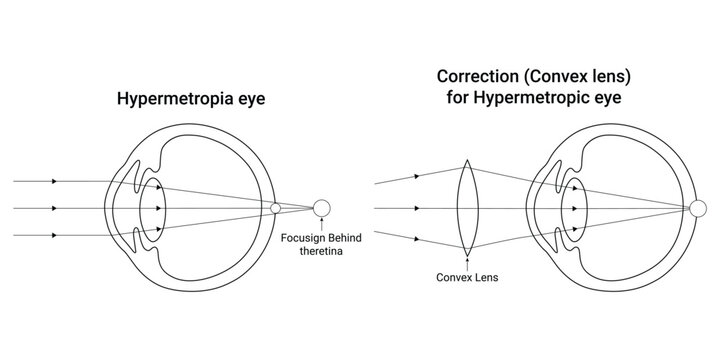 Hypermetropia eye Science Design Vector Illustration Diagram