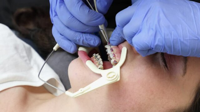 Orthodontist wearing medical gloves fixes braces on teeth of client. Close up top view. Concept of dentistry treatment for correction of malocclusion
