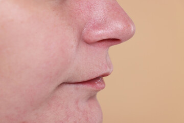 Closeup view of woman with blackheads on her nose against beige background, space for text