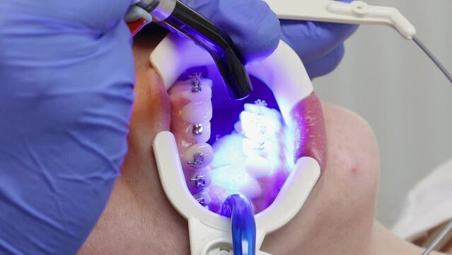 Orthodontist installs braces on teeth of young girl. Close-up. Concept of orthodontic treatment
