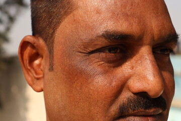 Closeup shot of an Indian Man Having dark spot under the eyes and around eyes